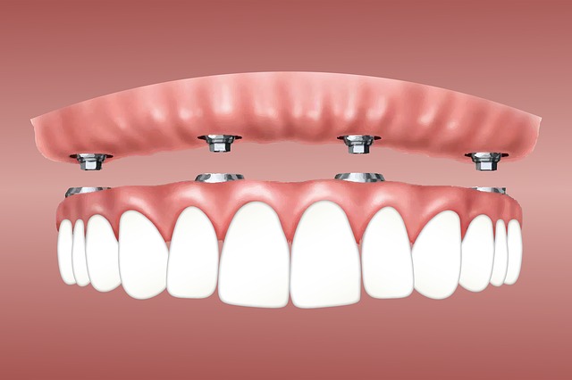 esquema de un implante dental