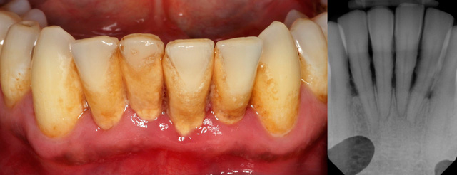 Periodoncia