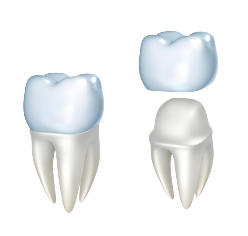 Prótesis Dental Fija: Todo Lo Que Necesitas Saber - Clínica Dental ...