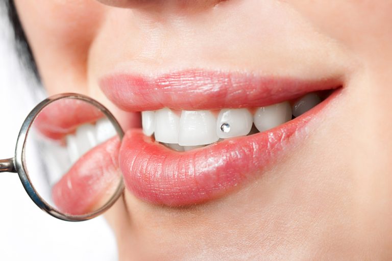 Piercing en el diente por qué esta joya dental sigue estando de moda Clínica Dental