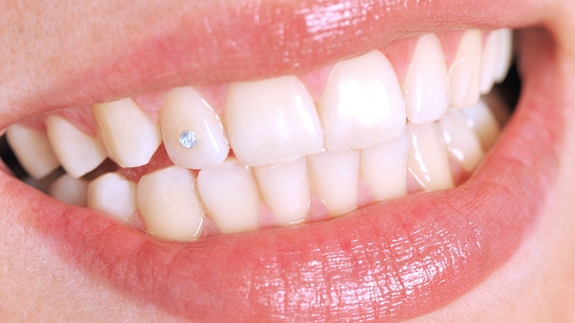 Piercing en el diente por qué esta joya dental sigue