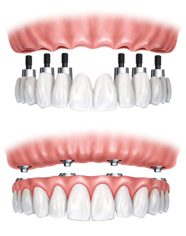 Prótesis dental híbrida