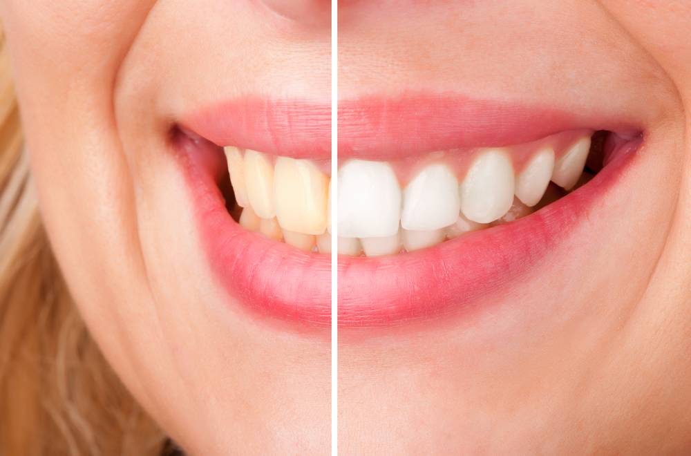 Blanqueamiento dental antes y después