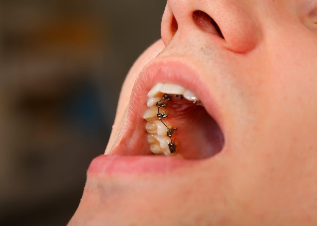 tratemiento ortodoncia lingual
