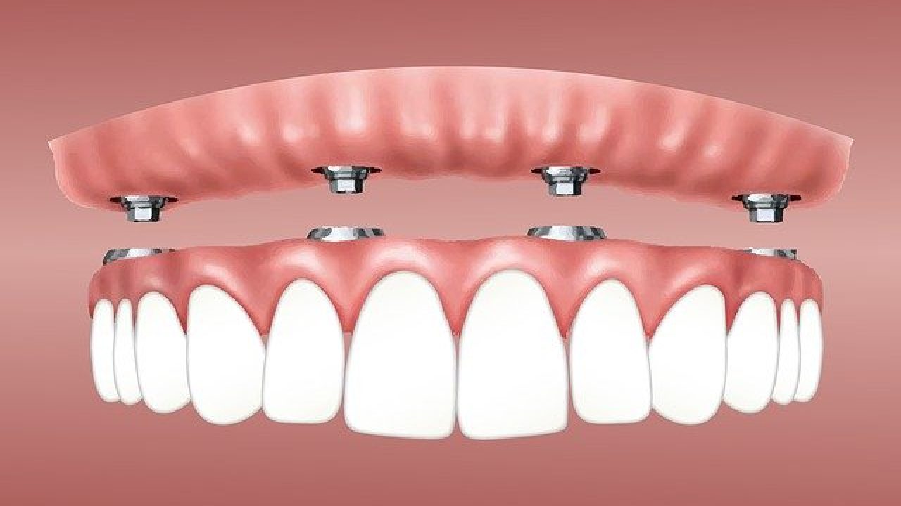 caja Álgebra carolino ▷Implantes dentales fijos: qué es, cuáles son los tipos que existen y cómo  se colocan - Clínica Dental Implantostetic